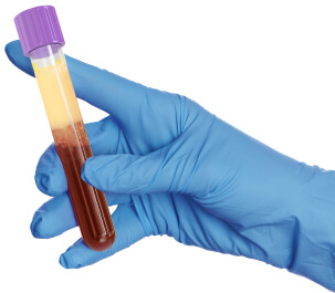 Lipemic blood sample