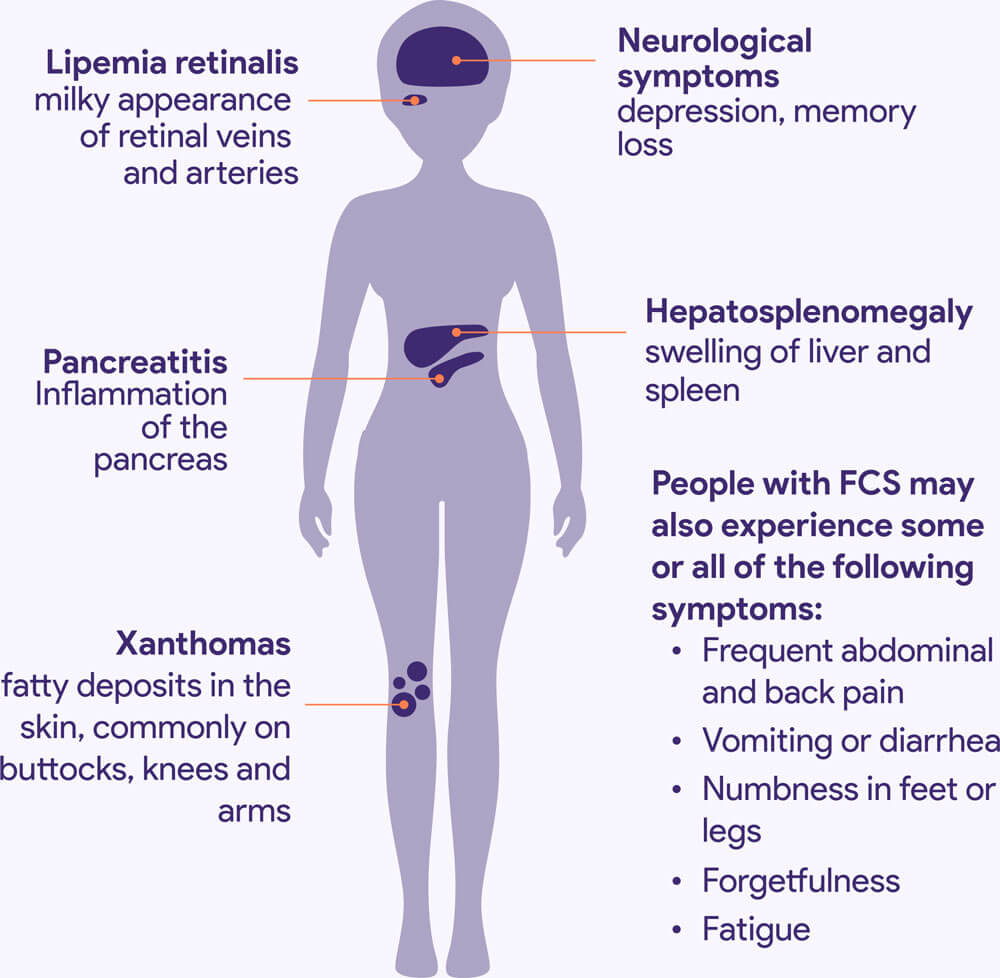 Signs and Symptoms of FCS